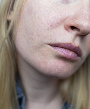A dermatologist examines a woman's face with dilated pores, pigmentation, and sebaceous filaments. Treatment of rosacea and skin inflammation.