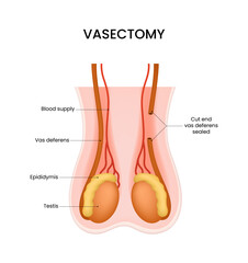 Vasectomy Medical Illustration of Male Sterilization