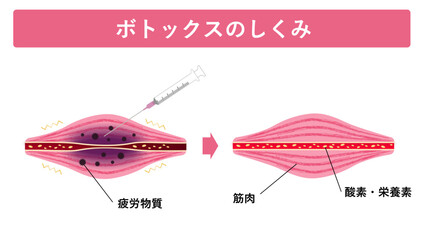 ボトックスのしくみ