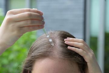 Close up of a woman applying serum to dry irritated and itchy scalp with a glass dropper. Concept...