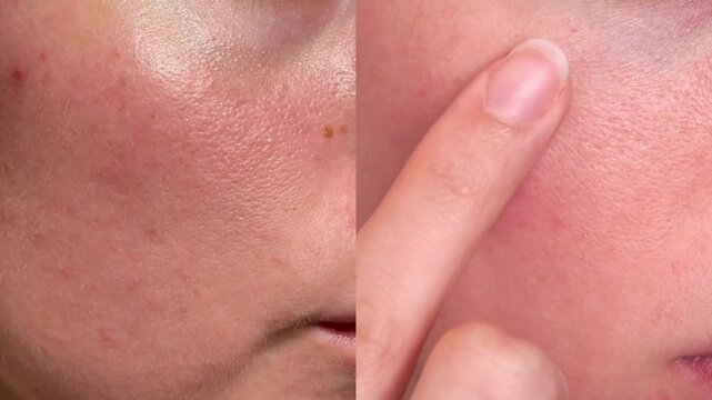 Realistic close-up video showing facial skin before and after skincare. Enlarged pores, acne marks, redness reduced to smoother, clearer texture. Ideal for dermatology, beauty content.