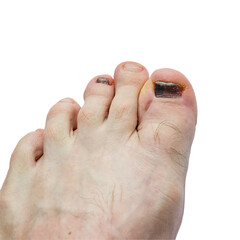 Photograph of a big toe with blood under the nail. red toenail. lesions and wounds, White...