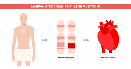 Marfan syndrome poster