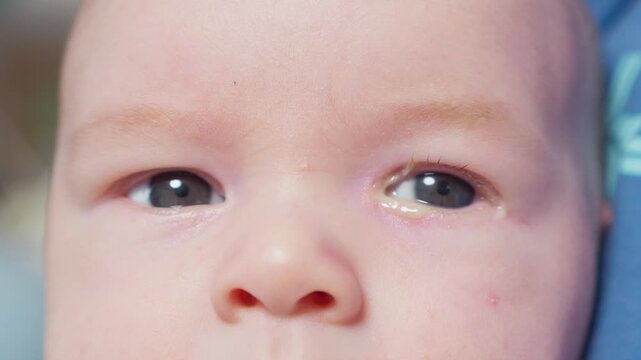 Baby eyes with eye mucus in selective focus. Disease tear ducts tons of newborns close up. Nasolacrimal duct obstruction in baby it is a blockage of the lacrimal drainage system. 