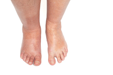 Swollen leg caused by a broken toe. Unrecognizable man with swollen feet, tired and painful legs.Edema lower limbs