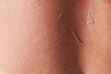 Fototapeta premium Woman with peeling skin from sunburn, closeup