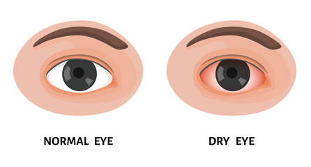 Normal eye and dry eye, irritated eye, redness, conjunctivitis