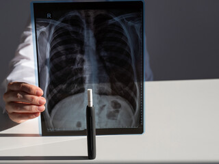 Doctor holding x-ray of lungs with e-cigarette in background. 