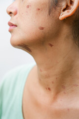 Portrait of an Indonesian woman with skin burn scars on her face and neck skin due to hot oil splatter while cooking