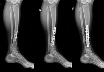 X ray showing tibia fracture repair with plate and screws