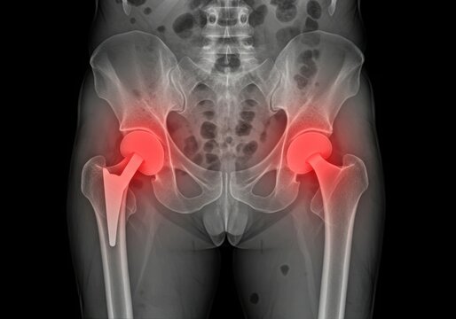 X ray of hips showing bilateral total hip replacement surgery