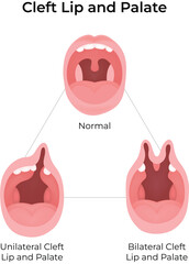 Cleft Lip and Palate Types and Anatomy