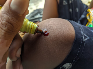 A person's hand applies brown antiseptic liquid from a yellow bottle onto a minor scrape on a child's dark skin knee. Focus on pediatric first aid.