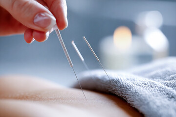 Traditional Chinese Acupuncture Treatment for Stress Relief, Close Up of Needles, Holistic Healing Concept, Wellness and Energy Healing, Alternative Medicine