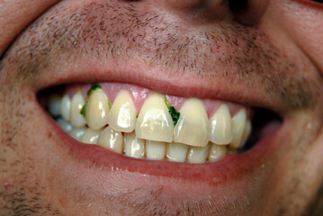 Man with spinach in his teeth.
