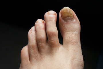 General stock - fungal toenail