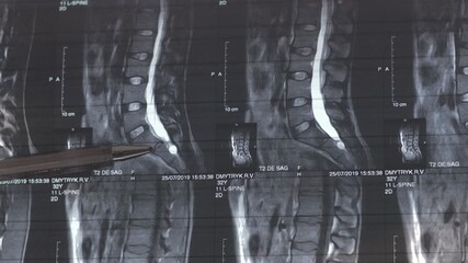 Doctor learning MRI of the lumbar spine. At level 12, an arachnoid cyst measuring 13x14 mm is identified on the left. 