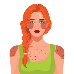 Vector portrait of a red-haired woman with sunburned skin. Honest representation of sun exposure. Useful for skincare, health, travel, and summer awareness topics.