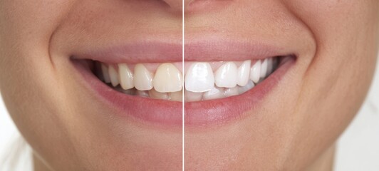 The transformative journey of a smile with dental whitening treatment.