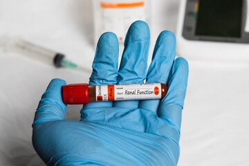 Renal Function- Test with a blood sample on a shiny blue hand. Health or medical concept. Bekasi, Indonesia - July 24, 2025.
