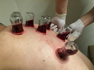 Wet Cupping Therapy Session with Practitioner Applying Glass Cups