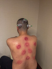 Cupping Therapy Marks on Back and Head with Suction Cups