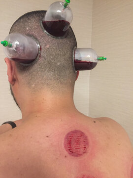 Wet Cupping Therapy on Head and Neck Area