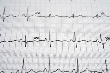 Electrocardiogram ECG, heart wave, heart attack, cardiogram report.