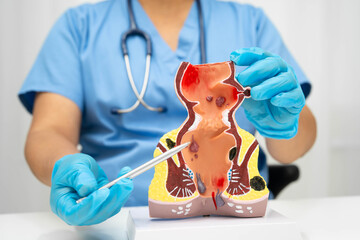 Asian doctor with rectum and hemorrhoid human anatomy model at hospital, inflamed vascular...