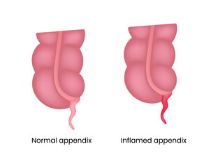 Normal and Inflamed Appendix Illustration