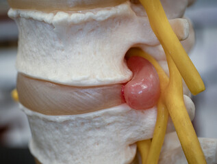 Herniated Disc Compressing Spinal Nerve in Model
