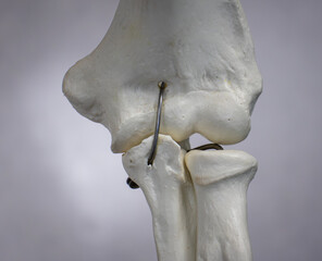 Anterior View of Elbow Joint With Radius, Ulna, and Humerus