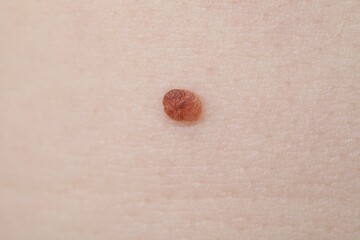 Woman with mole on her skin, macro view