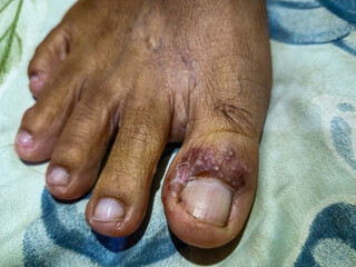 Appearance of the big toe of someone who has herpes