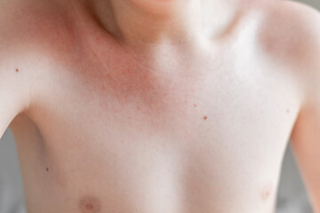 Preschool child with sun allergy and red burned skin on arm, shoulder, and chest. Small bumps and...