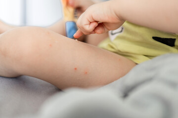 Small kid, child with many insect bites on body lying on bed, scratching legs and applying cream. Red bumps from mosquitoes or ants. Top view of toddler with big bites on back.