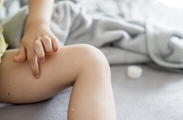 Small child, kid, sitting on a bed with visible insect bites on legs and feet, applying anti itch...