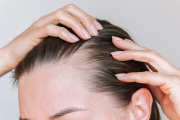 Fototapeta premium Young brunette woman suffering from hair loss showing her hair in the temple area with both hands. Woman's health. Baldness, the effects of the disease, lack of vitamins.