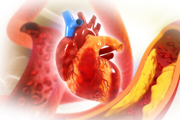 Human heart with cholesterol blocked artery, coronary artery disease, cholesterol plaque in artery. 3d illustration