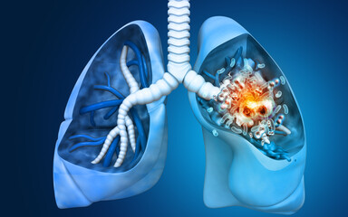 Human lungs diseases, infections and cancer. 3d illustration