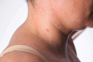 Red pimples and rashes on a woman's neck. Infectious diseases and allergic reactions, close-up