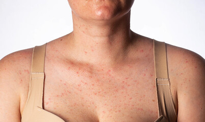 Red pimples and rashes on the skin of a woman's chest, close-up, allergic reaction to medication,...