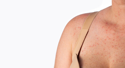 Red rashes and pimples on the skin of a woman's chest due to allergies, close-up. Copy space for...