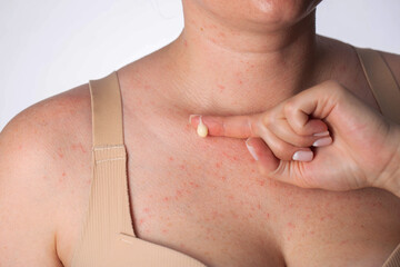 A girl smears red pimples on her body skin with healing ointment after dermatological irritation,...