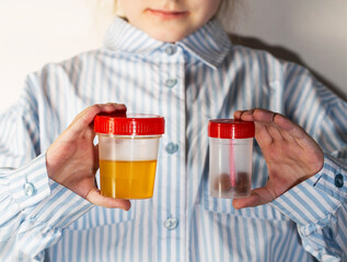 A child holds a urine and stool test in his hands. The concept of testing children for infections,...