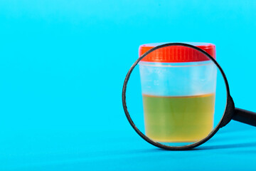 Container with urine test under a magnifying glass on a blue background. Hematuria and protein in...