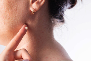 Medicinal anti-inflammatory cream for eliminating rashes and pimples on the skin of the body,...