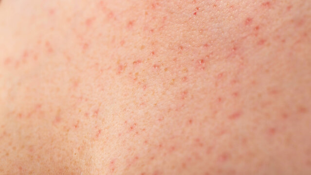 Red pimples and rashes on female skin. Concept of chronic dermatological diseases, allergy to drugs, eczema