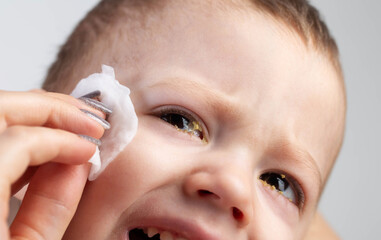 Treatment of the eyes of a little boy with viral purulent conjunctivitis. Wiping and hygiene of the...
