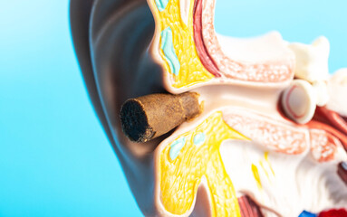 Earwax plug in the ear canal of the ear model, close-up. Copy space for text